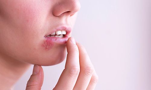 Mengenal Sindrom Stevens-Johnson (SJS) dan Cara Penanganannya