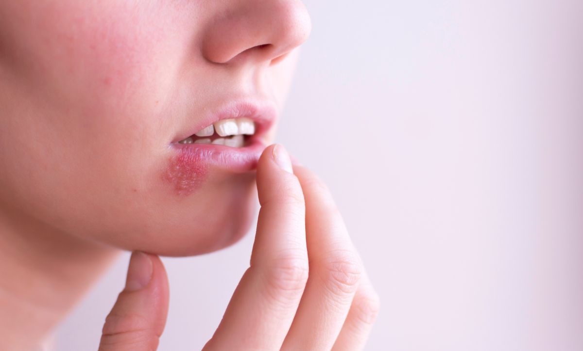 Mengenal Sindrom Stevens-Johnson (SJS) dan Cara Penanganannya